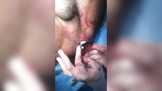 WTF?: Foreign object removal.